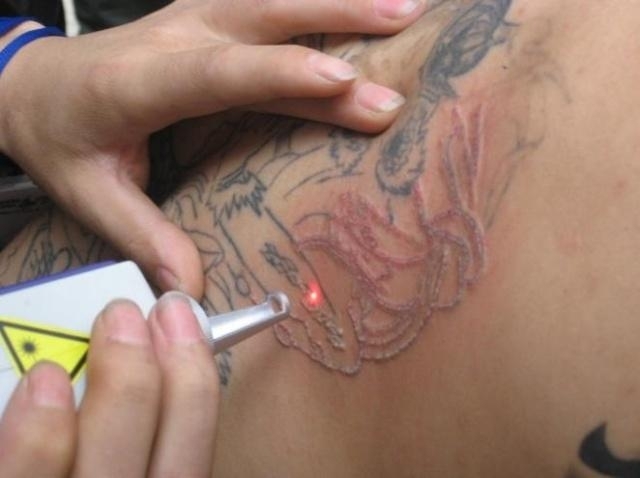 Все про как удалить татуировку